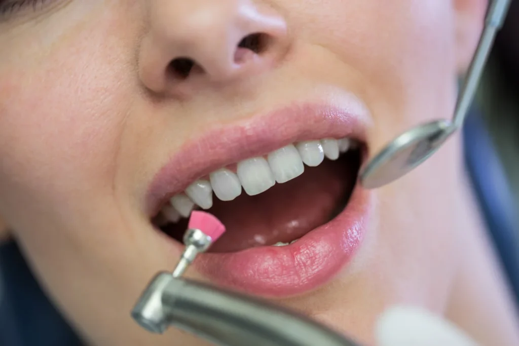 Dental teeth polishing