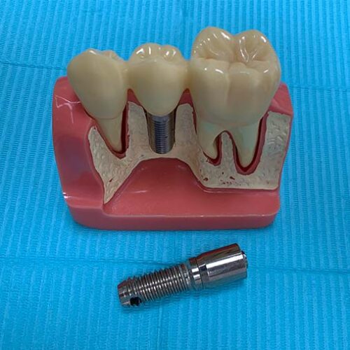 An enlarged model of Dental Implants