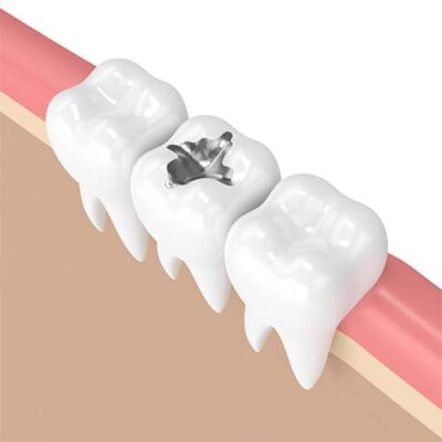 Diagram of an amalgam mercury alloy filling