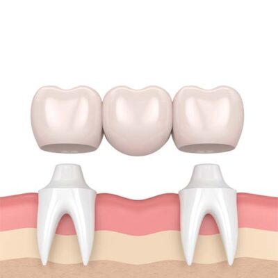 Dental Bridge