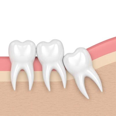 Diagram of an impacted wisdom tooth encroaching on normal healthy teeth