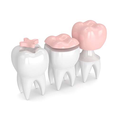 Porcelain Onlay, Inlays and a Crown 3D diagram