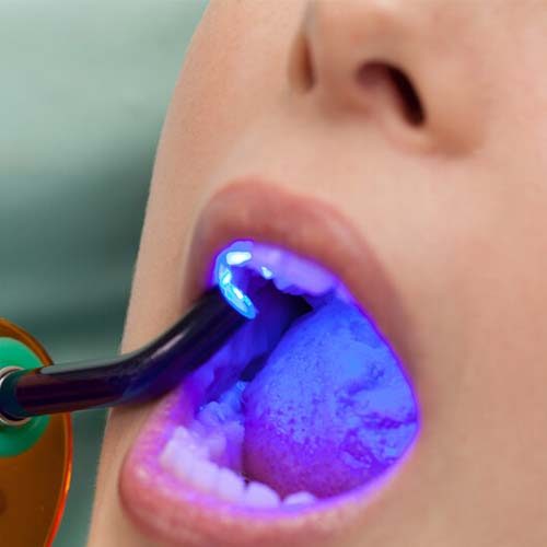 UV light used to harden composite tooth fillings
