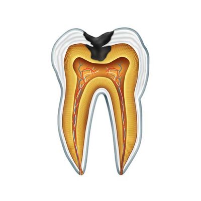 A diagram of a tooth cavity from side on