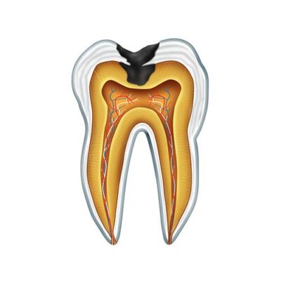 A diagram of a tooth cavity from side on