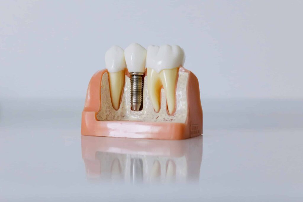 Endosteal Implants: Your Ultimate Solution for Dentures Implants