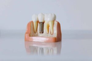 Endosteal Implants: Your Ultimate Solution for Dentures Implants