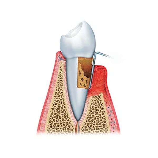 What is gum disease? | Finkelstein Dentist